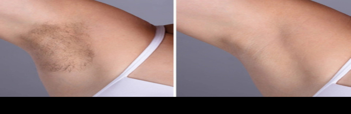 Laser Hair Removal Cover Image
