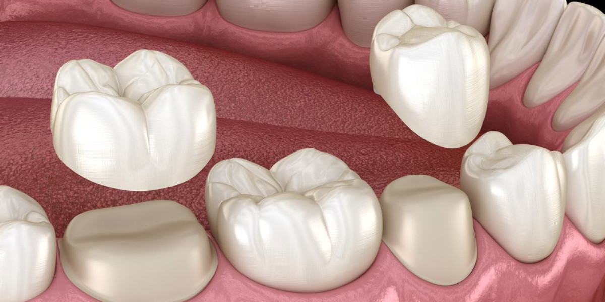 When Do You Need a Dental Crown Dubai Treatment?
