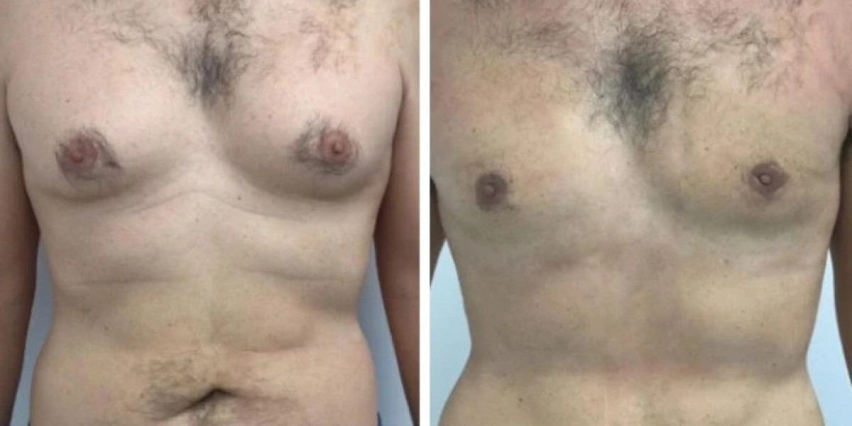 How the Best Gynecomastia Surgeons in dubai Ensure Safe Outcomes