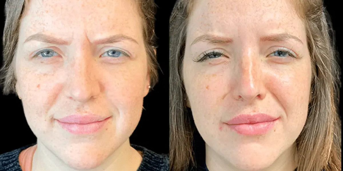 Botox Treatment in Dubai Using Advanced Techniques