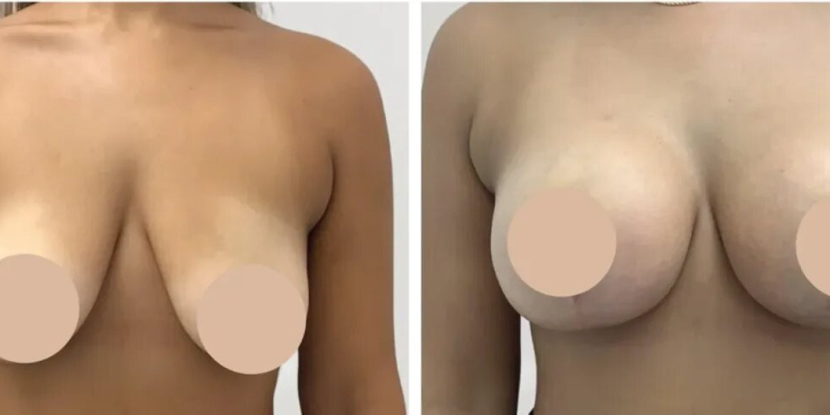Breast Reduction in Dubai for Enhanced Posture and Lifestyle