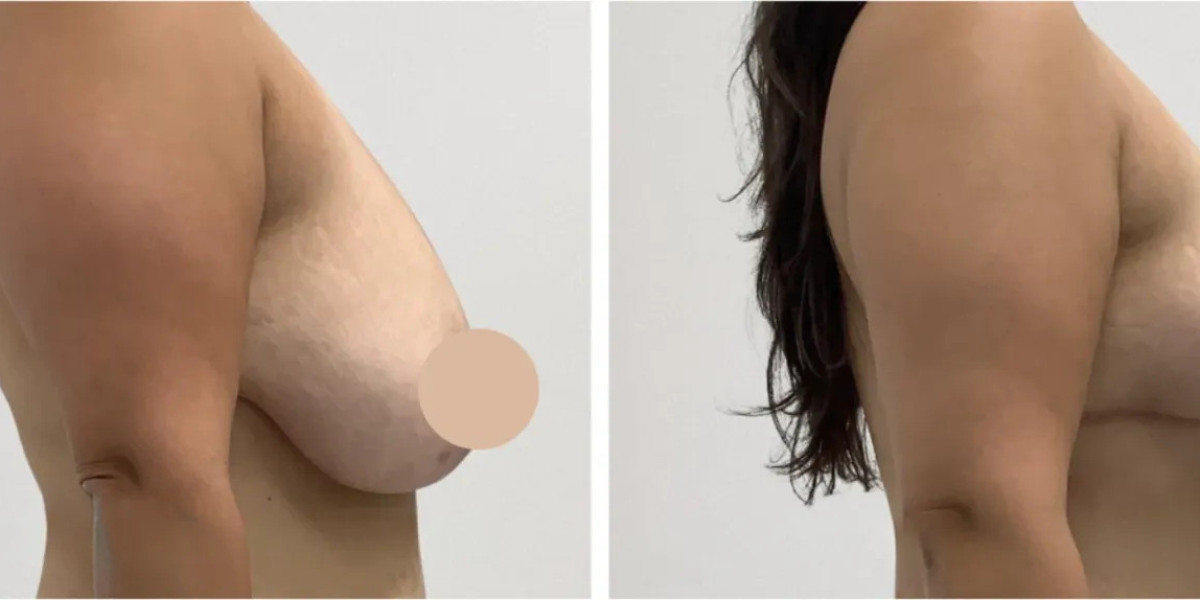 Breast Lift in Dubai: A Modern Solution for Youthful Shape
