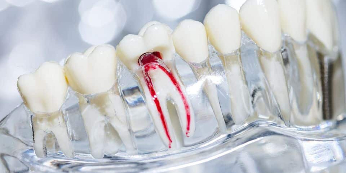 Root Canal Treatment: Signs, Process & Myths Busted