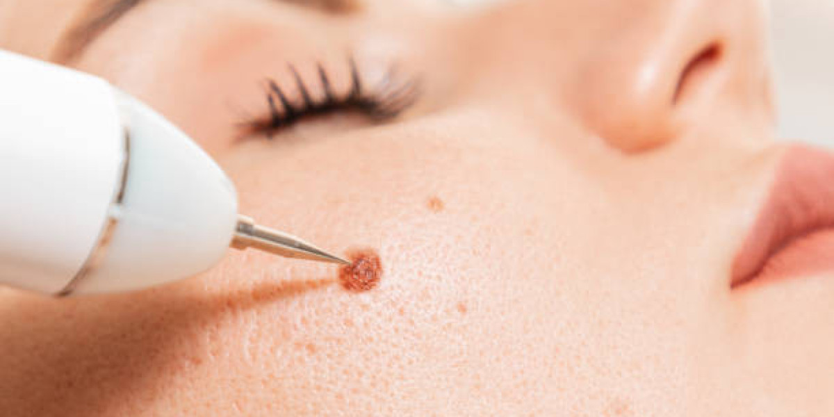 Advanced Care Approaches in Mole Removal