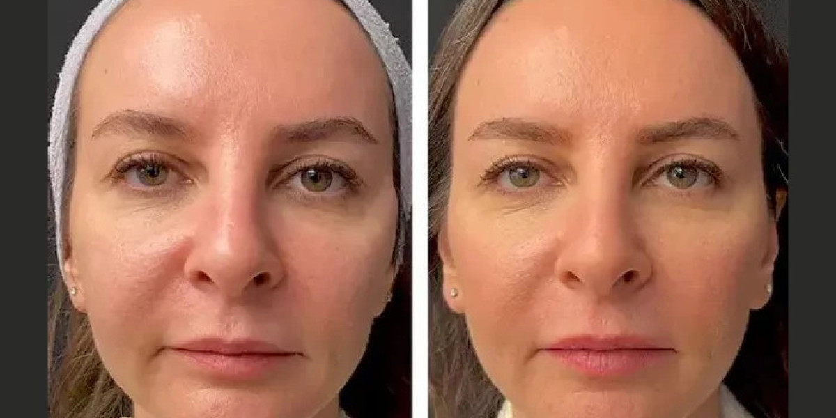 Mesotherapy Treatment in Dubai Compared to Other Aesthetic Treatments