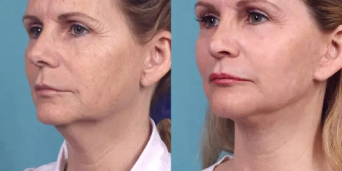 Chemical Peel Treatments in Dubai: How They Support Skin Cell Turnover
