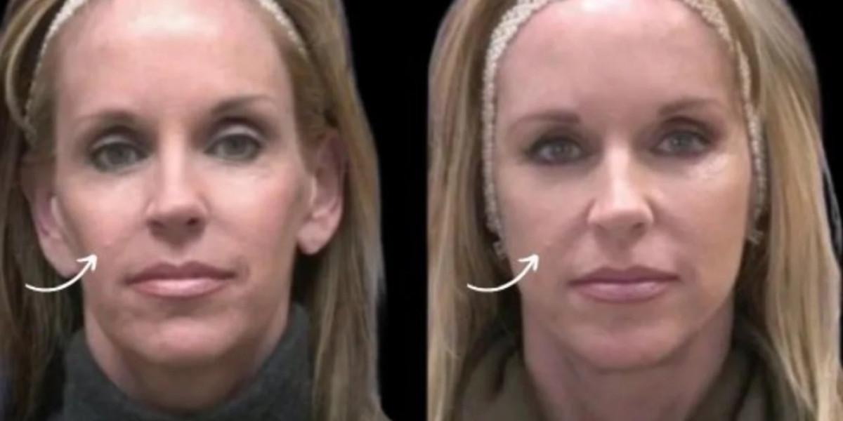 Best Plastic Surgeons in Dubai: Correcting Facial Asymmetry with Sculptra