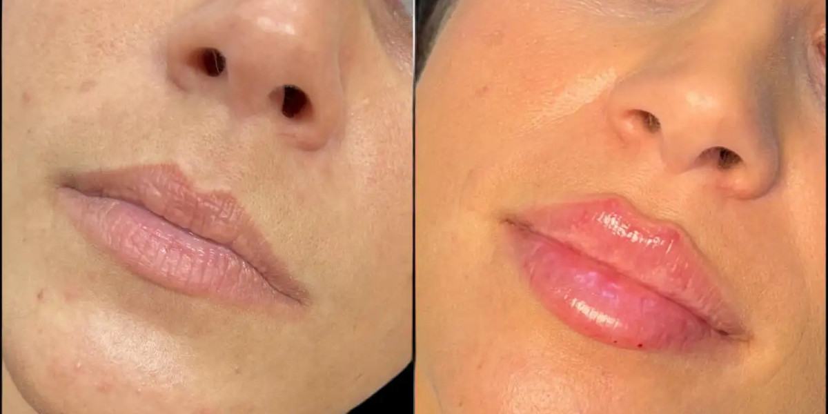 Best Plastic Surgeon in Dubai for Russian Lip Fillers Balanced Lip Contouring
