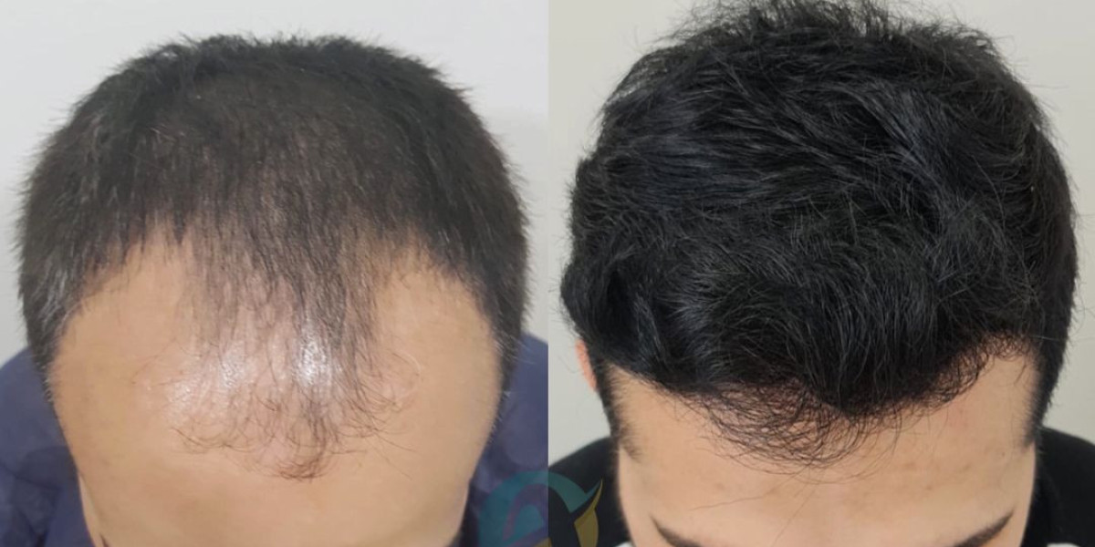 Hair Transplant in Islamabad: Permanent Solution for Thinning Hair