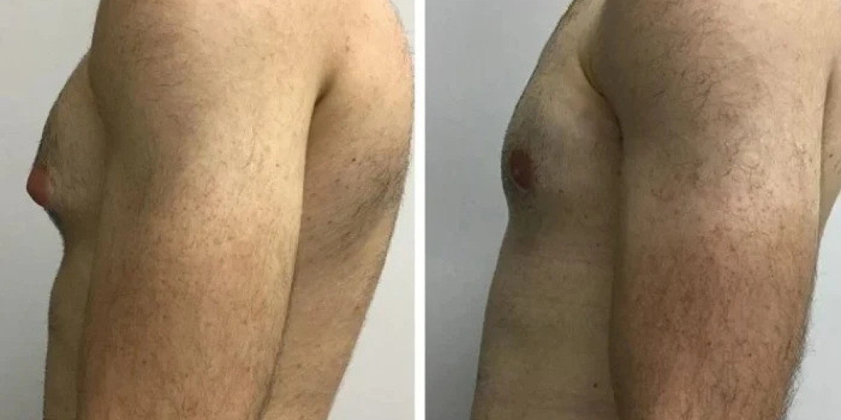 Gynecomastia Surgery in Dubai: Transform Your Appearance with Skilled Surgeons