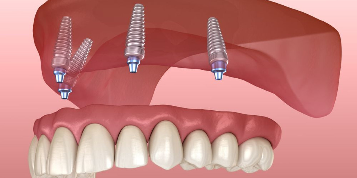 All-on-4 Dental Implants: Who’s a Good Candidate?