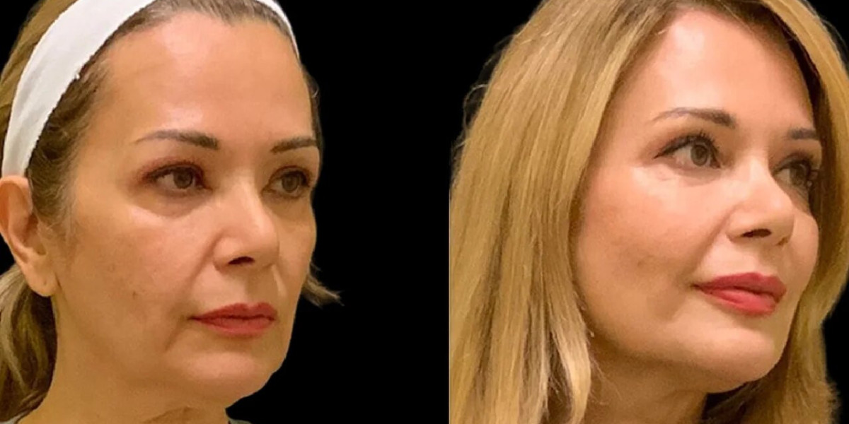 Best Aesthetic Clinic in Dubai Explains Layered Cheek Fillers