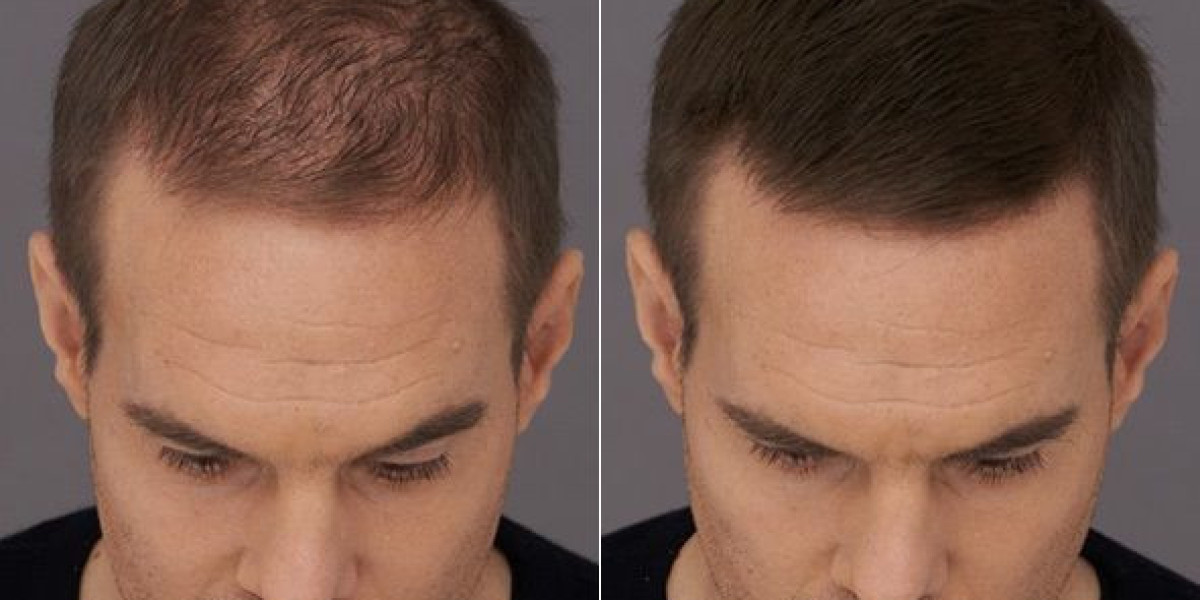 How Precision Techniques Enhance Every Hair Transplant Result