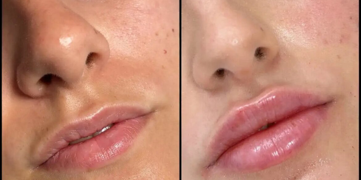 Best Plastic Surgeon in Dubai for Fillers: Redefining Non-Surgical Beauty