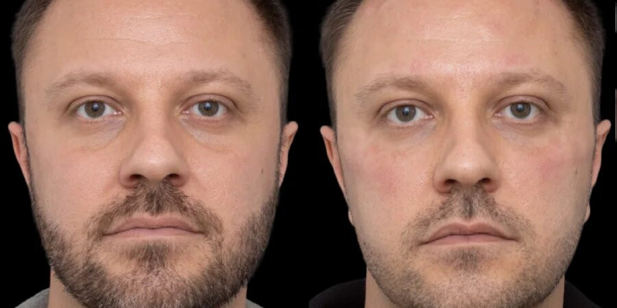 Best Aesthetic Clinic in Dubai for Expert Under Eye Fillers Guidance